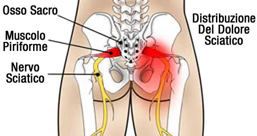 sciatica
