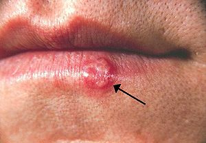 papilloma herpes