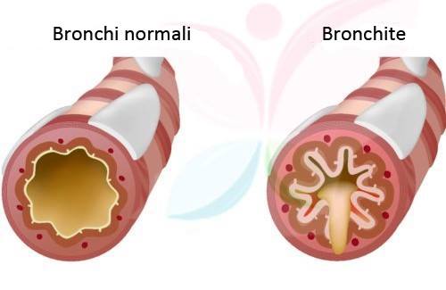 bronchite sintomi