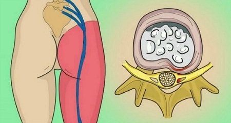 sciatica