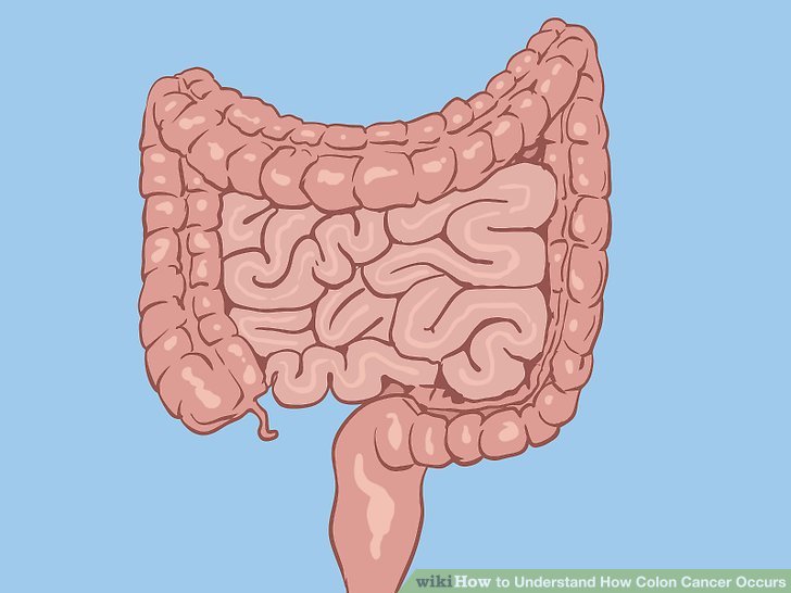 tumore al colon
