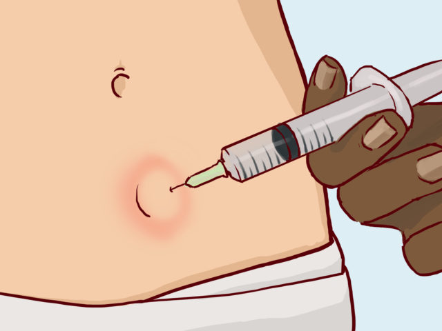 lipoma