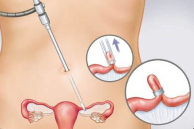 metodi contraccettivi