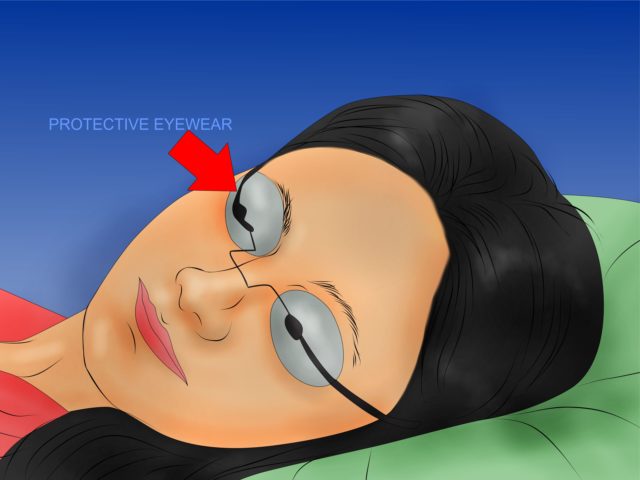 depilazione laser