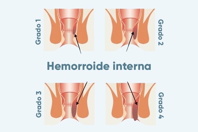 emorroidi interne