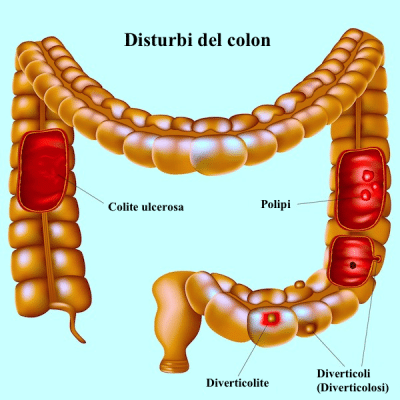 sangue nelle feci