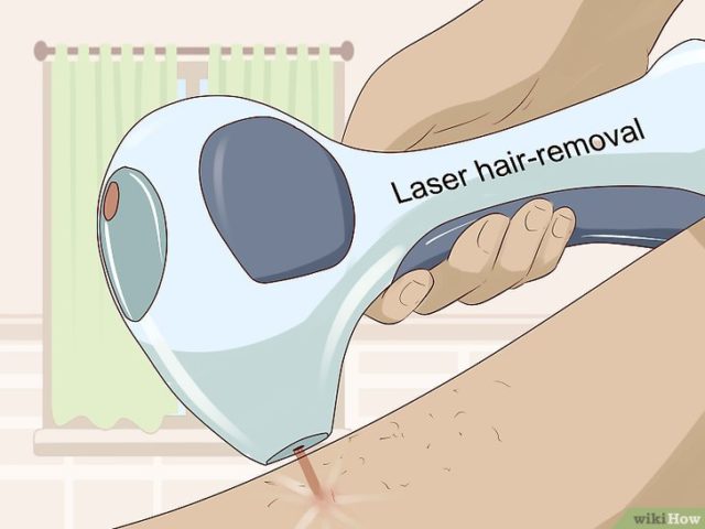 depilazione laser