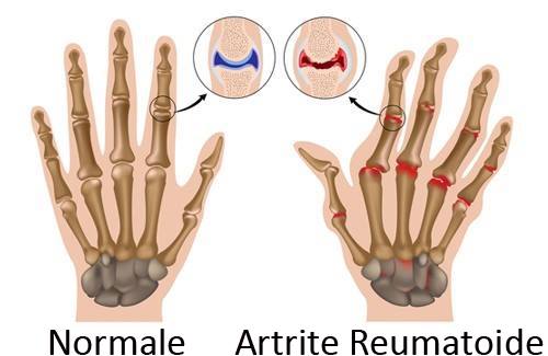 artrite reumatoide