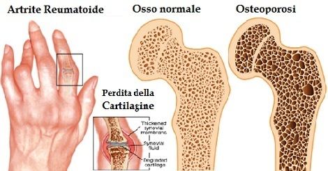artrite reumatoide