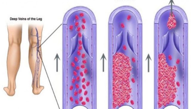 flebite