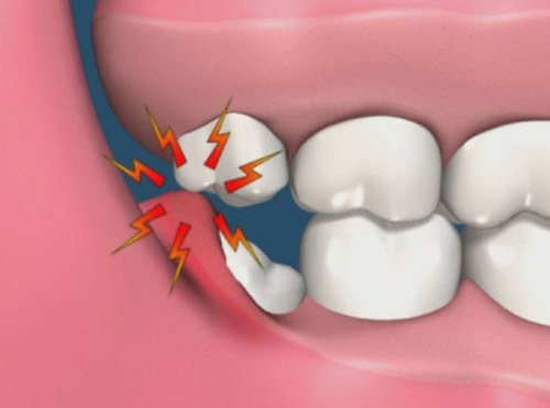 Denti del giudizio