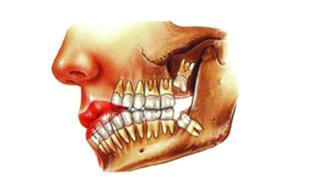 Denti del giudizio