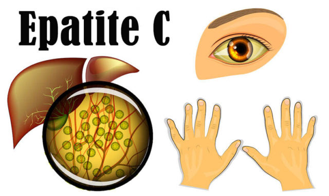 Epatite C