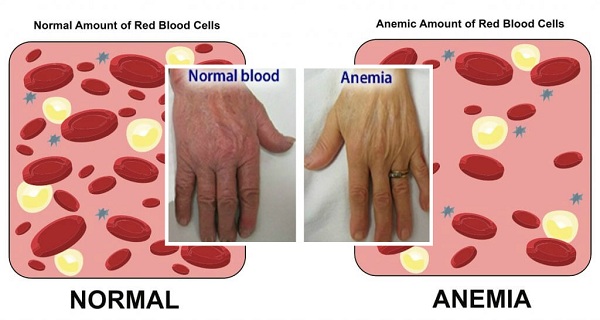 Anemia: Cause, rischi, dieta e come trattarla in tempo