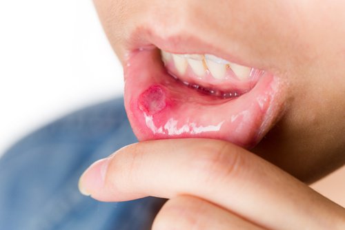 Hai un’afta in bocca? Ecco 8 rimedi naturali che ti aiuteranno a liberartene