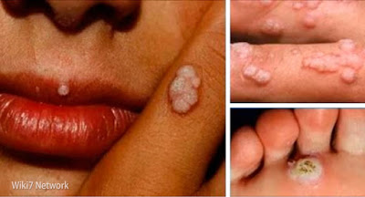 Papilloma virus e herpes labiale Tratăm condiloamele la bărbați