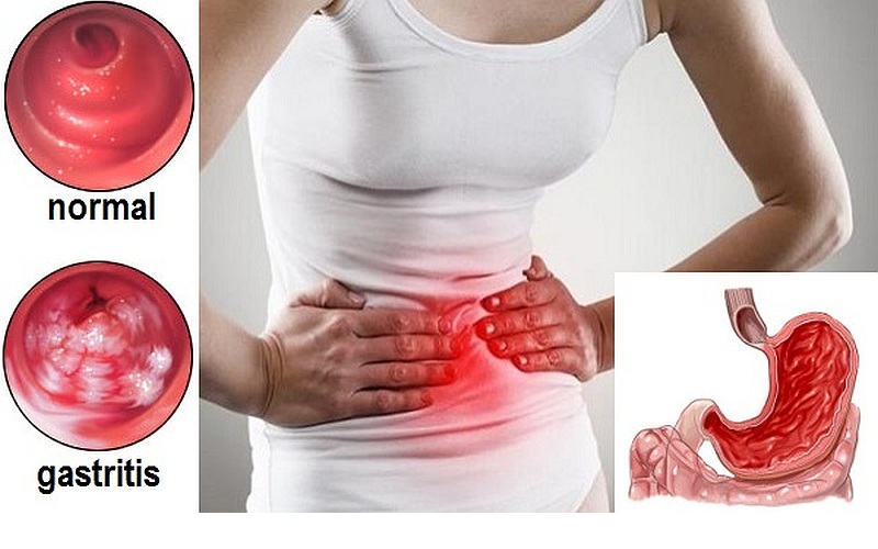 Gastrite: 10 sintomi frequenti per riconoscerla e trattarla in modo definitivo!