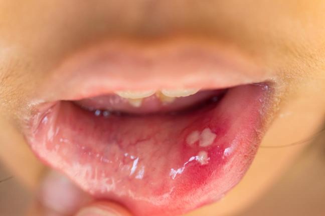 papilloma sul labbro inferiore perioada de tratament a condiloamelor