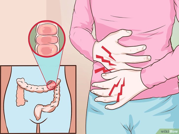 Soffri di Colite? 10 sintomi che lo dimostrano e come curarla naturalmente