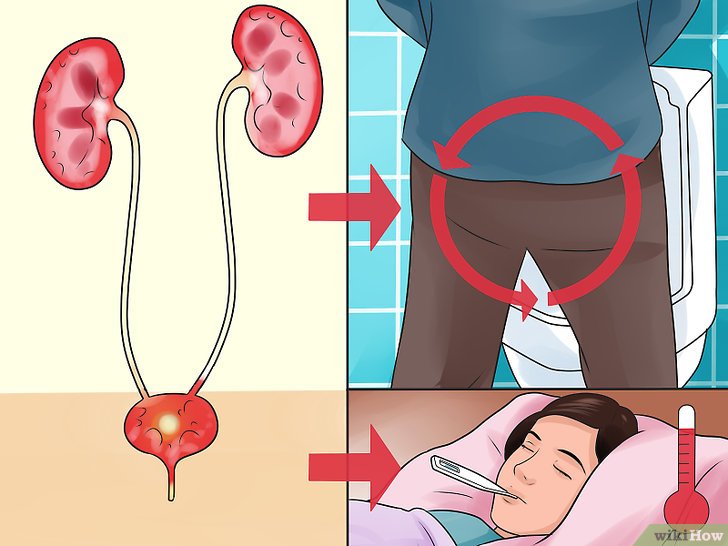 Infezione vie urinarie: sintomi e cosa mangiare per combatterla!