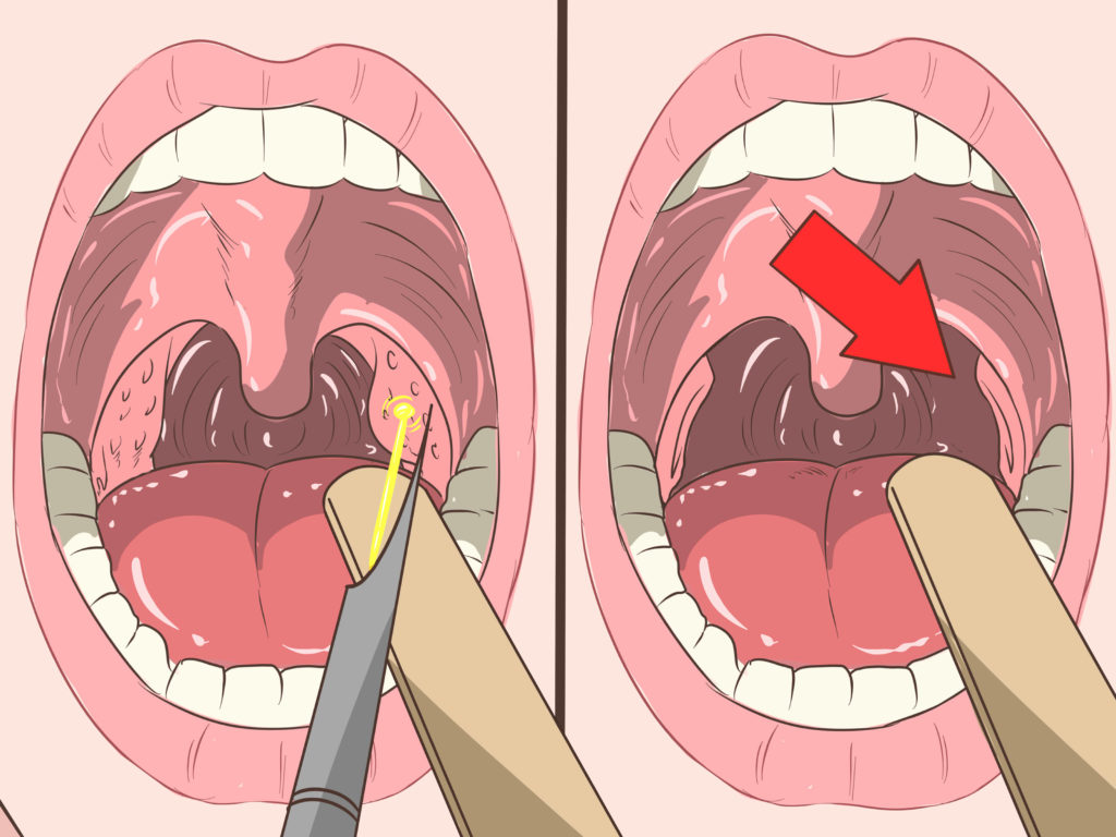 Placche alla gola: 6 Sintomi che si tratta di tonsillite e prova questi 2 rimedi