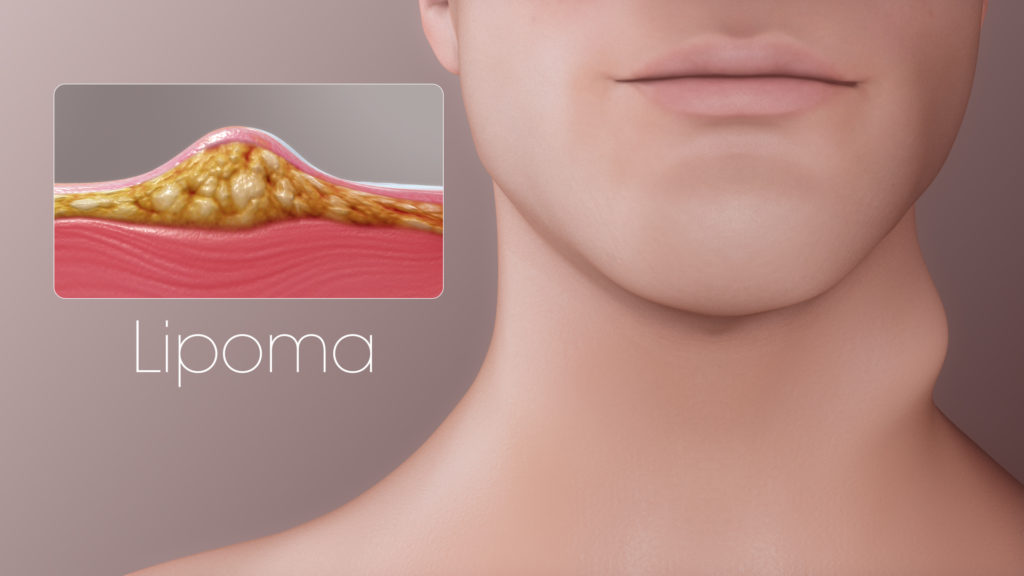 Como Eliminar Lipomas De Grasa Sin Cirugia Lipoma: 3 sintomi per riconoscerlo e quando può diventare pericoloso