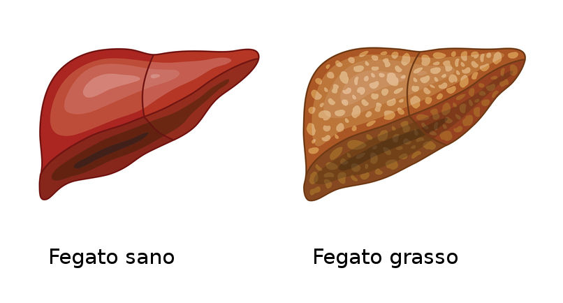 Fegato ingrossato: 5 sintomi per riconoscerlo e dieta per la steatosi epatica