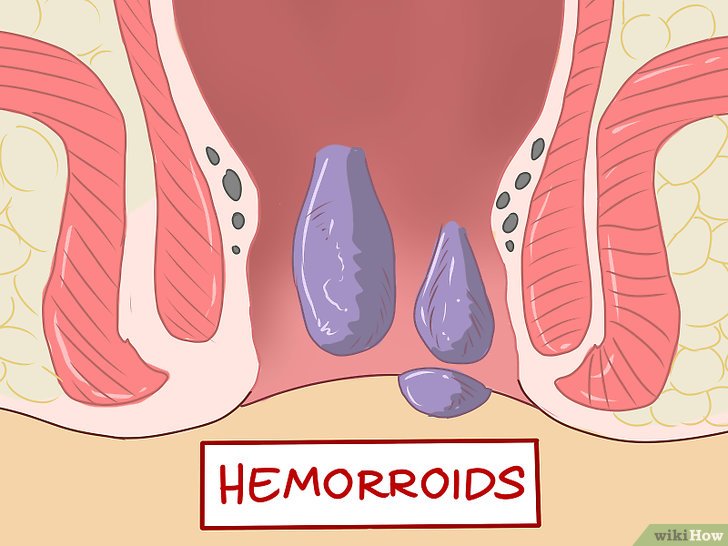 Emorroidi interne: 4 Sintomi per riconoscere la loro gravità e come agire