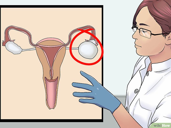 Cisti ovarica: 10 sintomi per riconoscerle e come prevenirle con questi rimedi