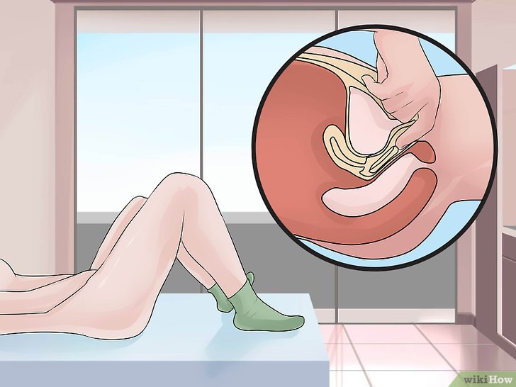 Anello anticoncezionale vaginale: Nuvaring come usarlo ed effetti collaterali