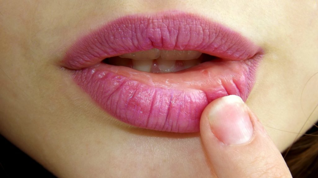 Labbra screpolate, addio! 10 Rimedi perfetti per curare le labbra secche