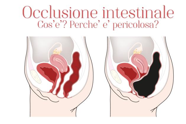 Blocco intestinale: Quali sono i sintomi, cause e le cure contro l’ostruzione?