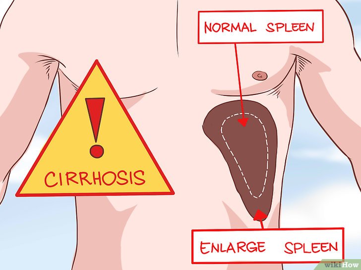 Cirrosi epatica: 10 Sintomi per riconoscerla, Cause e 3 rimedi per trattarla