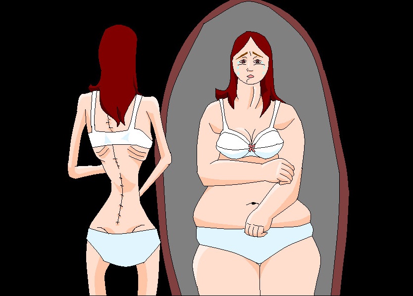 Anoressia nervosa: Sintomi per riconoscerla, Cause e come curarla