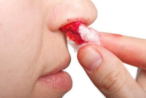 Sangue dal naso, è pericoloso? Come fermarlo con questi 7 rimedi naturali