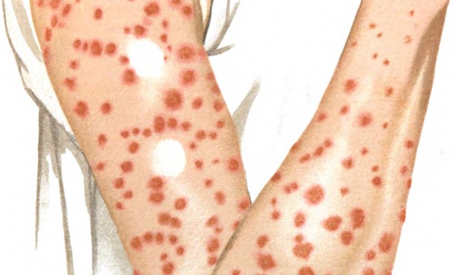 La Sifilide si cura? Ecco i sintomi e 3 rimedi per combatterla