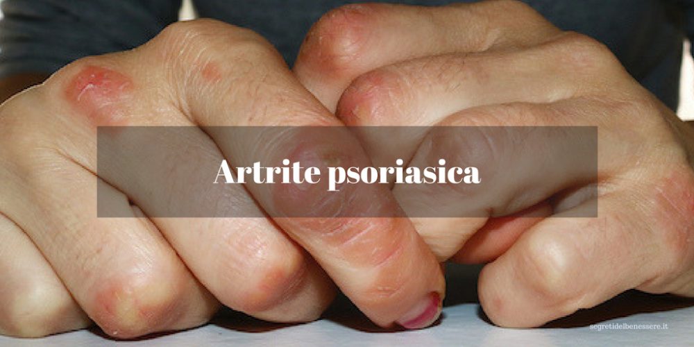 Artrite psoriasica: Cause, sintomi e come curarla in tempo