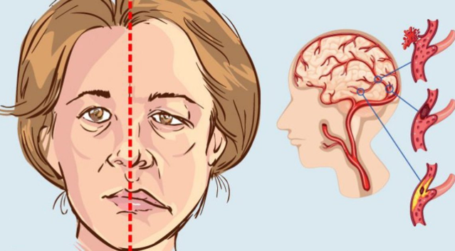 Ischemia cerebrale o Ictus: Quali sono i sintomi, le conseguenze e le cure?
