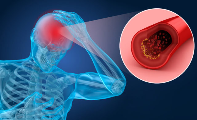 ischemia cerebrale