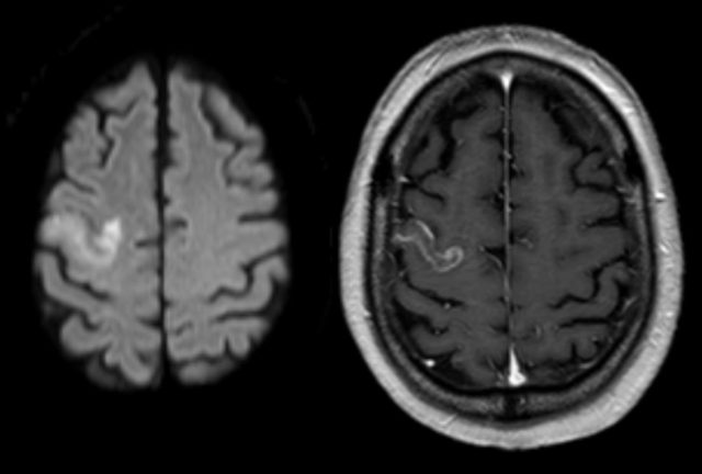 ischemia cerebrale radiografia