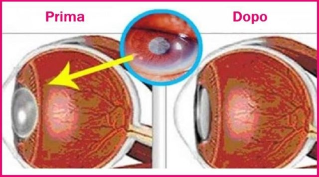 Ecco la spezia che migliora la vista del 97% e protegge la retina!