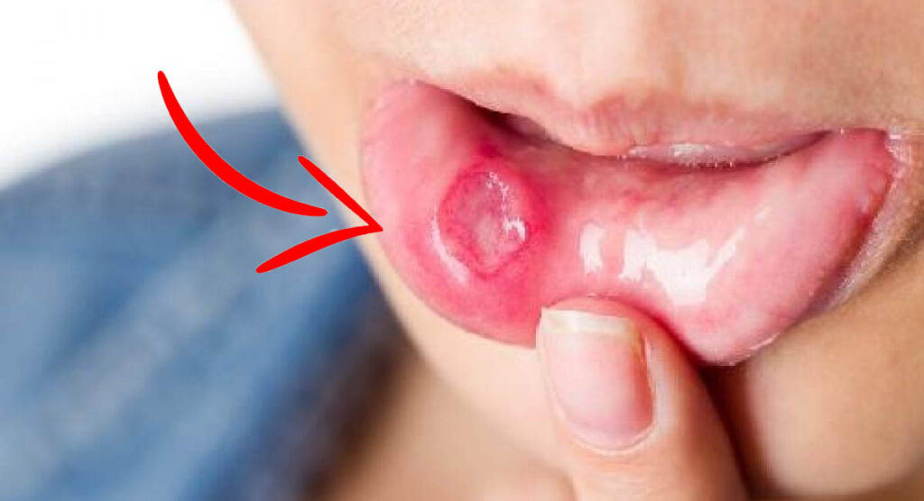 Sapevate che la carenza di questa vitamina causa afte alla bocca, pelle secca e fiato corto?