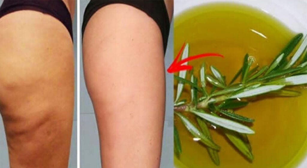 L’alcool al rosmarino, 2 soli ingredienti per combattere cellulite e vene varicose