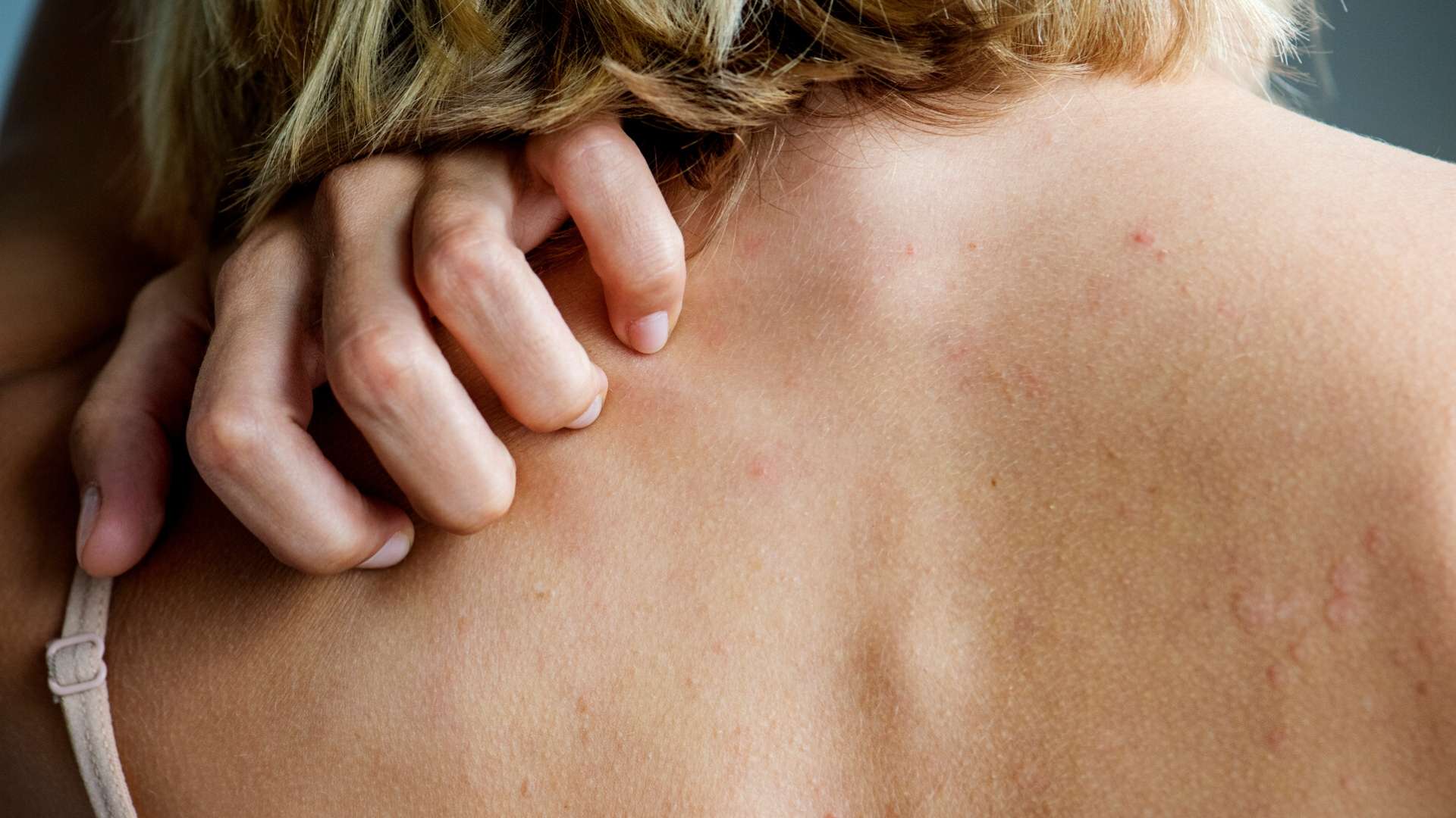 Prurito alla schiena