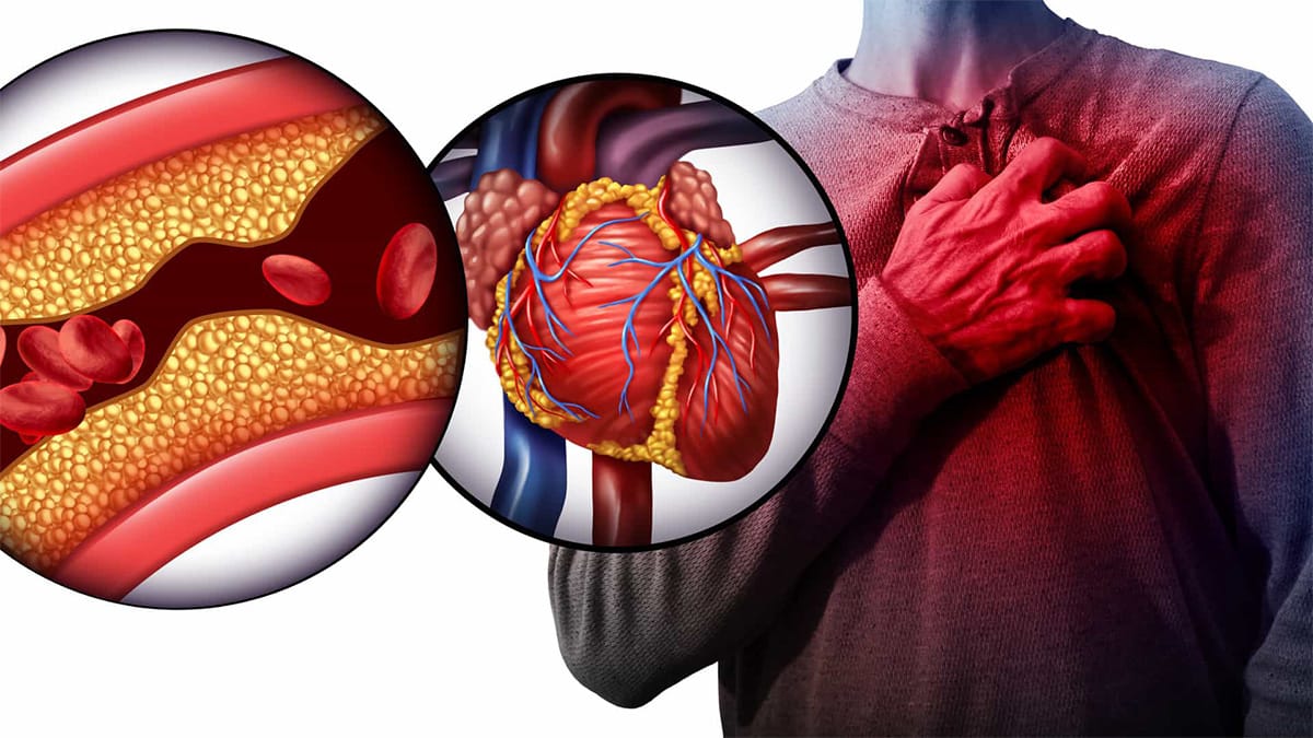 10 cibi che aiutano a pulire le arterie