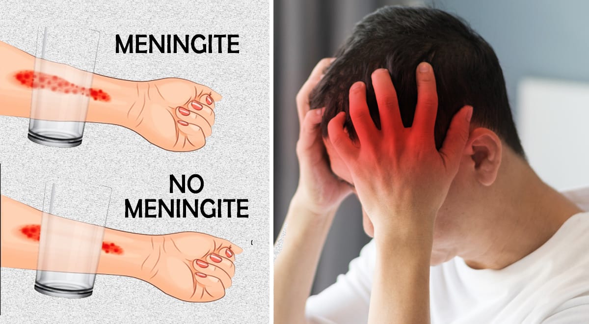 Meningite, sintomi iniziali