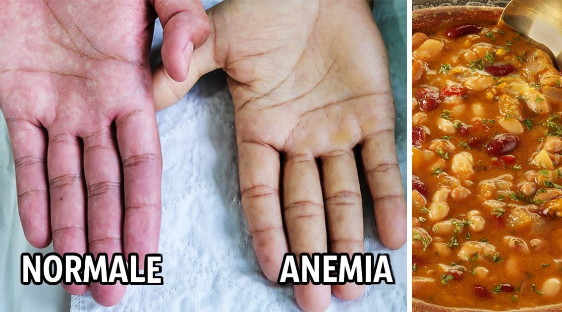 9 cibi ricchi di ferro contro l'anemia