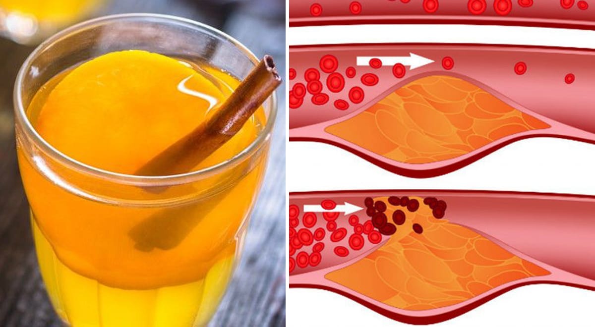 La bevanda cannella e limone, per abbassare colesterolo e glicemia