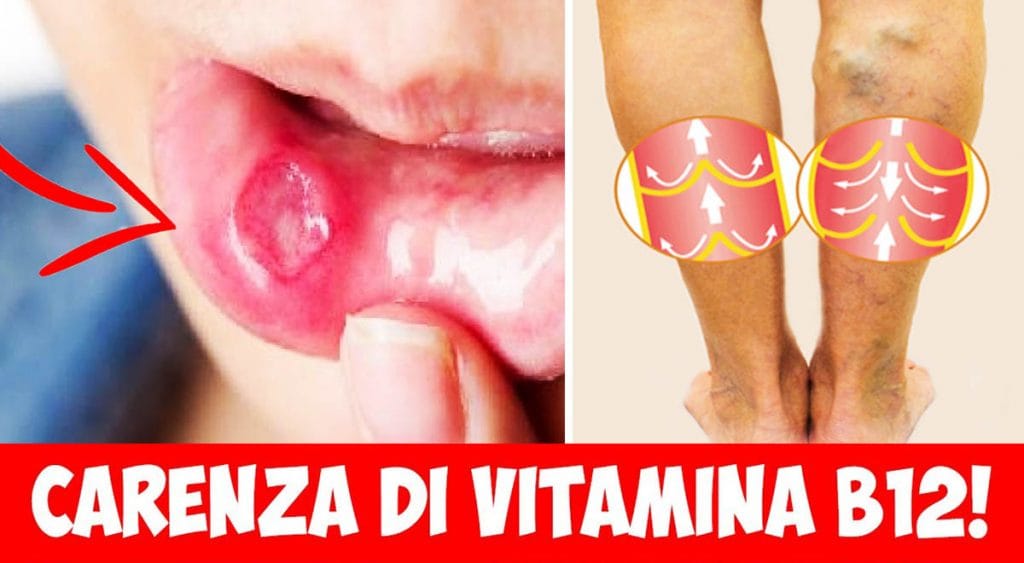 Vitamina B12, 14 sintomi anche gravi dovuti ad una sua carenza. Attenzione!