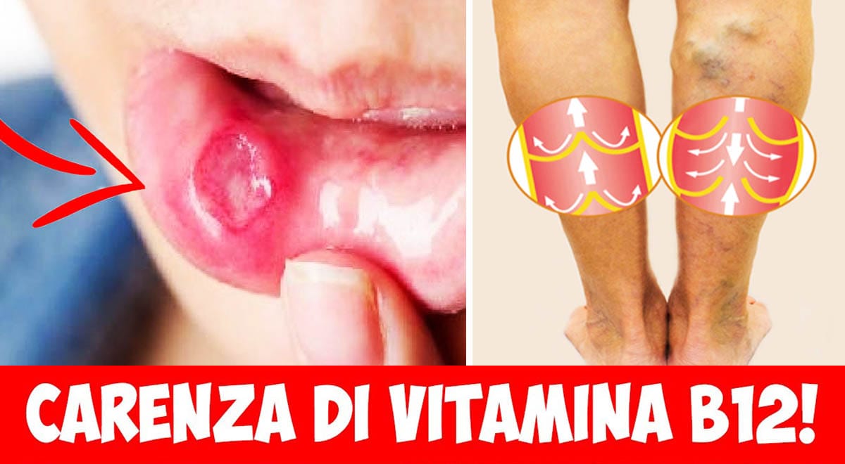 Carenza di vitamina B12